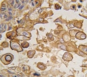 IHC analysis of FFPE human lung carcinoma tissue stained with TLR6 antibody