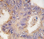 IHC analysis of FFPE human colon carcinoma tissue stained with TRAF2 antibody