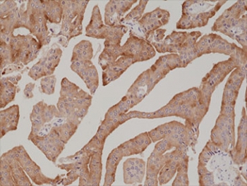 IHC staining of FFPE human prostate cancer tissue with recombinant Prostate Specific Antigen antibody at 1:1000.