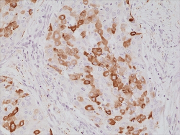 IHC staining of FFPE human lung cancer tissue with recombinant Surfactant protein A antibody at 1:1000.~