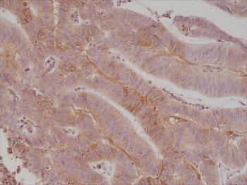 IHC staining of FFPE human colon cancer tissue with recombi