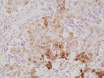 IHC staining of FFPE human lung cancer tissue with recombinant Cyclooxygenase 2 antibody a