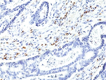 IHC staining of FFPE human colon cancer tissue with recombinant CD5 antibody at 1:1000.
