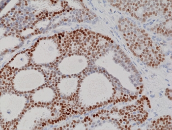 IHC staining of FFPE human breast cancer tissue with recombinant PR anti