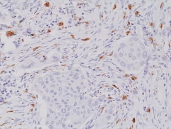 IHC staining of FFPE human lung cancer tissue with recombinant CD117 antibody at 1:2000.