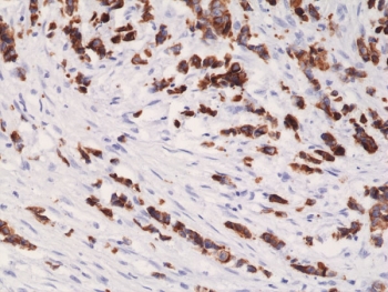 IHC staining of FFPE human breast cancer tissue with recombinant Cytokeratin 19 antibody at 1:1000.~
