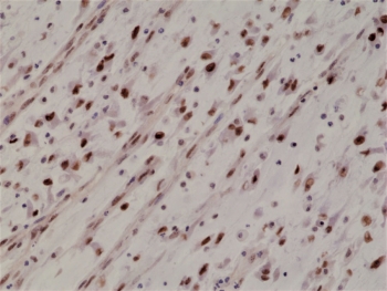 IHC staining of FFPE human Rhabdomyosarcoma tissue with recombinant Myogenin D1 antibody