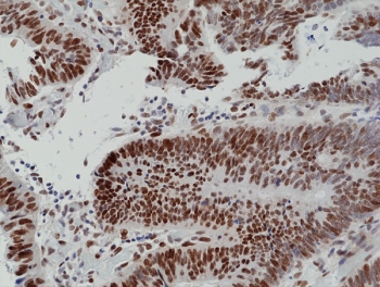 IHC staining of FFPE human colon cancer tissue with recombina