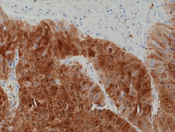 IHC staining of FFPE human liver cancer tissue with recombinant Arginase-1 antibody at 1:1250.~