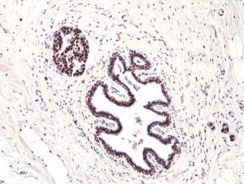 IHC staining of FFPE human breast ductal carcinoma tissue with recombinant FO