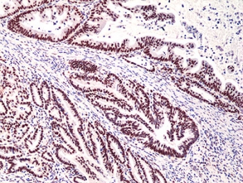 IHC staining of FFPE human colon cancer tissue with recombinant MSH3 antibody at 1:200.