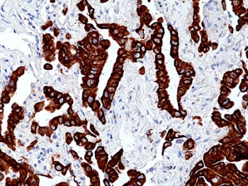 IHC staining of FFPE human lung adenocarcinoma tissue with recombinant Keratin 7 antibody at 1:100.~