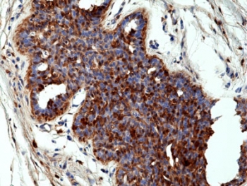 IHC staining of FFPE human breast cancer tissue with recombinant ANXA1 antibody at 1:100.