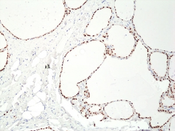 IHC staining of FFPE human thyroid tissue with recombinant PAX8 antibody at 1:400.~