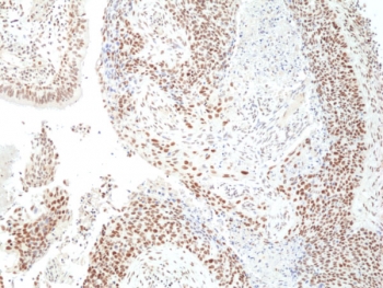 IHC staining of FFPE human lung squamous carcinoma tissue with recombinant HDCAC3 antibody at 1:200.