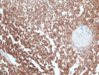 IHC staining of FFPE human gastrointestinal stroma tissue with recombinant DOG1 antibody at 1:100.