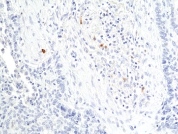 IHC staining of FFPE human lung squamous carcinoma tissue with recombinant Granzyme B antibody at 1:200.~