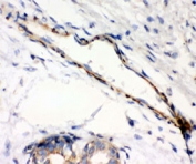 IHC testing of FFPE human breast cancer with Caldesmon antibody (clone CD-7). HIER: steamed with pH6 citrate buffer.