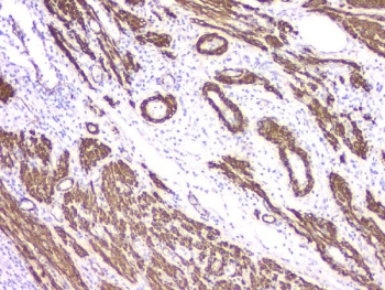 IHC staining of FFPE human endometrial carcinoma tissue with ACTA2 antibody. HIER: boil tissue sections in pH8 EDTA for 20 min and allow to cool before testing.