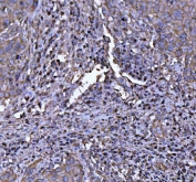 IHC staining of FFPE human squamous cell cervical carcinoma tissue with NLRP3 antibody. HIER: boil tissue sections in pH8 EDTA for 20 min and allow to cool before testing.