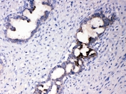 IHC testing of FFPE human breast cancer tissue with ATF6 antibody at 1ug/ml. Required HIER: steam section in pH6 citrate buffer for 20 min and allow to cool prior to testing.