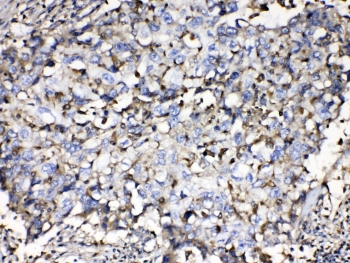IHC testing of FFPE human lung cancer tissue with Beta-2 Microglobulin antibody at 1ug/ml. Required HIER: steam section in pH6 citrate buffer for 20 min and allow to cool prior to testing.