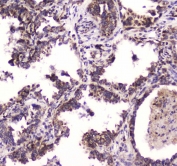 IHC testing of FFPE human lung cancer tissue with BRD7 antibody at 1ug/ml. Required HIER: steam section in pH6 citrate buffer for 20 min and allow to cool prior to staining.