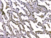 IHC staining of FFPE human lung cancer with TGFB2 antibody. HIER: boil tissue sections in pH6, 10mM citrate buffer, for 10-20 min and allow to cool before testing.
