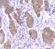 IHC testing of FFPE human breast cancer with SMN1/2 antibody. HIER: boil tissue sections in pH6, 10mM citrate buffer, for 10-20 min followed by cooling at RT for 20 min.
