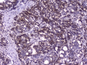 IHC staining of FFPE human stomach cancer with Capicua antibody at 1ug/ml. HIER: boil tissue sections in pH6, 10mM citrate buffer, for 10-20 min followed by cooling at RT for 20 min.