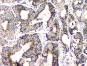 IHC staining of FFPE human intestinal cancer with FH antibody. HIER: boil tissue sections in pH8 EDTA for 20 min and allow to cool before testing.