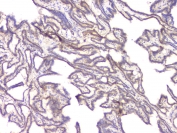 IHC staining of FFPE human thyroid cancer with BMP15 antibody at 1ug/ml. HIER: boil tissue sections in pH6, 10mM citrate buffer, for 10-20 min and allow to cool before testing.