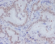 IHC staining of FFPE human colon carcinoma with CD11b antibody. HIER: boil tissue sections in pH6, 10mM citrate buffer, for 10-20 min followed by cooling at RT for 20 min.