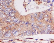 IHC staining of FFPE human colon cancer with E-Cadherin antibody. HIER: boil tissue sections in pH6, 10mM citrate buffer, for 10-20 min and allow to cool before testing.