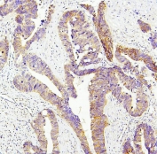 IHC staining of FFPE human intestinal cancer with SIRT1 antibody. HIER: boil tissue sections in pH6, 10mM citrate buffer, for 20 min and allow to cool before testing.
