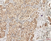 IHC staining of FFPE human breast cancer with DDX5 antibody. HIER: boil tissue sections in pH6, 10mM citrate buffer, for 20 min and allow to cool before testing.