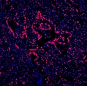 Immunofluorescent staining of FFPE human intestinal cancer with DDX5 antibody (red) and DAPI nuclear stain (blue). HIER: steam section in pH8 EDTA for 20 min.