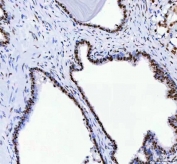 IHC staining of FFPE human prostatic acinar adenocarcinoma tissue with DDX1 antibody. HIER: boil tissue sections in pH8 EDTA for 20 min and allow to cool before testing.