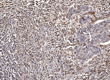IHC staining of FFPE human lung cancer tissue with ACADM antibody. HIER: boil tissue sections in pH8 EDTA for 20 min and allow to cool before testing.