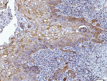 IHC staining of FFPE human laryngeal squamous cell carcinoma tissue with HRS antibody. HIER: boil tissue sections in pH8 EDTA for 20 min and allow to cool before testing.