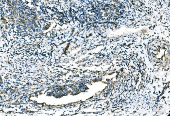 IHC staining of FFPE human cervical cancer tissue with C-C chemokine receptor type 2 antibody. HIER: boil tissue sections in pH8 EDTA for 20 min and allow to cool before testing.