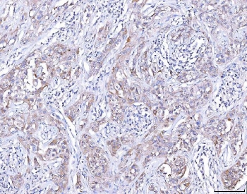 IHC staining of FFPE human lymphoma tissue with CCR7 antibody. HIER: boil ti