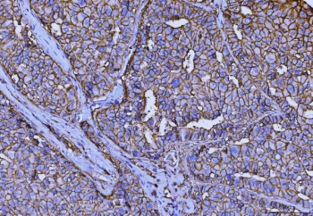 IHC staining of FFPE human hepatocellular carcinoma tissue with Emmprin antibody. HIER: boil tissue sections in pH8 EDTA for 20 min and allow to cool before testing.