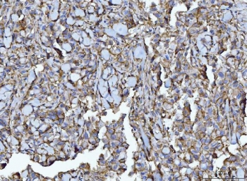 IHC staining of FFPE human breast infiltrating ductal carcinoma tissue with Emmprin antibody. HIER: boil tissue sections in pH8 EDTA for 20 min and allow to cool before testing.