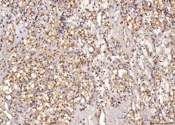 IHC staining of FFPE human renal clear cell carcinoma tissue with Sorbitol Dehydrogenase antibody. HIER: boil tissue sections in pH8 EDTA for 20 min and allow to cool before testing.