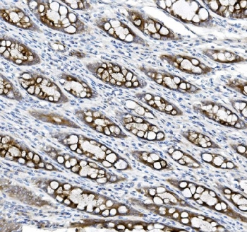 IHC staining of FFPE human rectal cancer tissue with MUC5B antibody. HIER: boil tissue sections in pH8 EDTA for 20 min and allow to cool before testing.~
