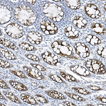 IHC staining of FFPE human rectal cancer tissue with MUC5B antibody. HIER: boil tissue sections