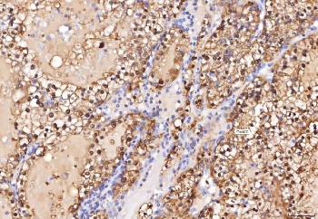 IHC staining of FFPE human renal cell carcinoma tissue with ENO1 antibody. HIER: boil tissue sections in pH8 EDTA for 20 min and allow to cool before testing.