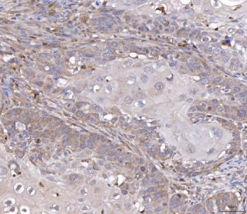 IHC staining of FFPE human laryngeal squamous cell carcinoma tissue with FIS1 antibody. HIER: boil tissue sections in pH8 EDTA for 20 min and allow to cool before testing.