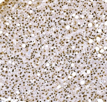 IHC staining of FFPE human liver cancer tissue with H1F0 antibody. HIER: boil tissue sections in pH8 EDTA for 20 min and allow to cool before testing.